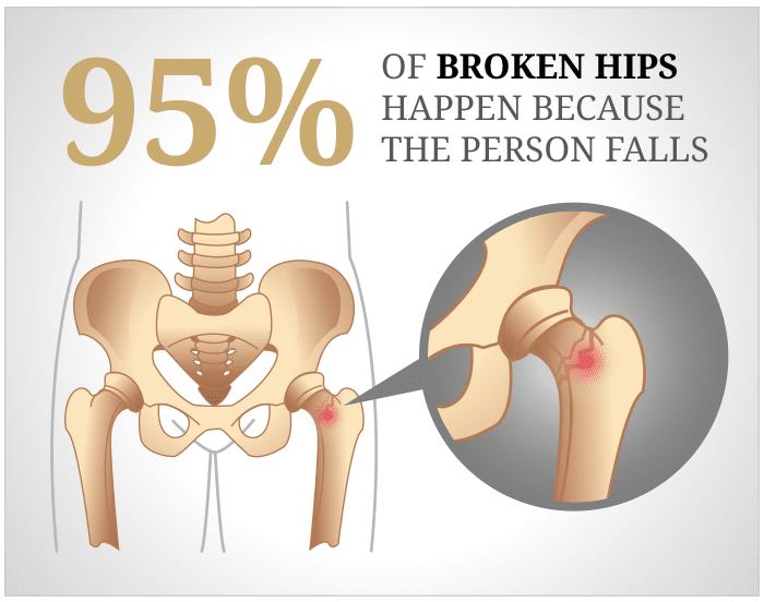 https://beckerlaw.com/assets/img/2017/11/diagram-broken-hips.png