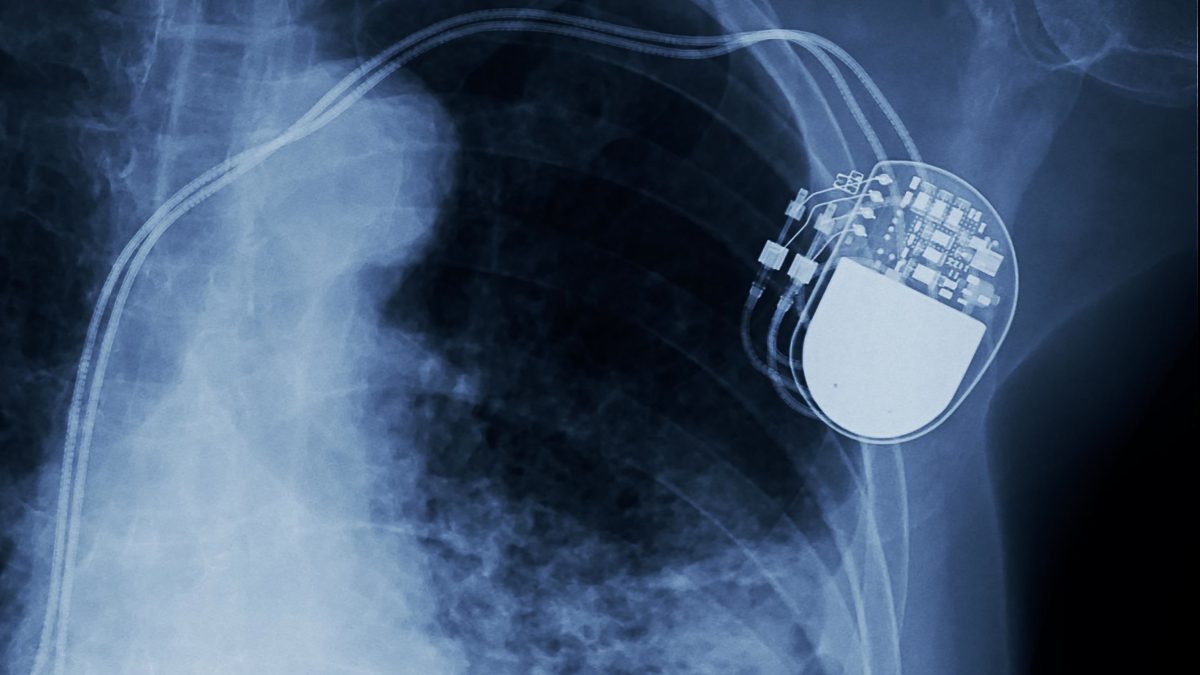 can you smoke cigarettes with a pacemaker Things to Avoid Open Heart Surgery, a Pacemaker,