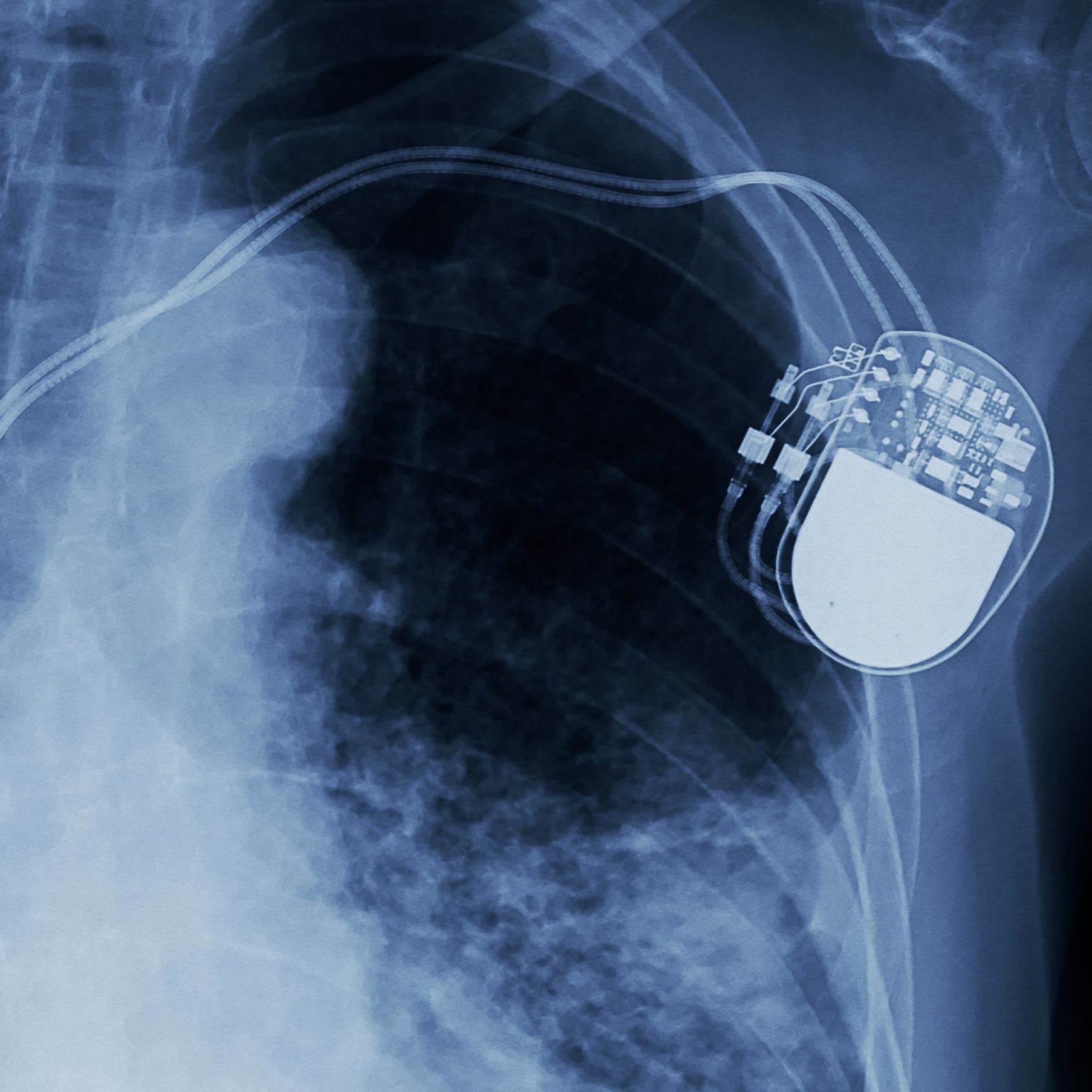FDA Recalls 465,000 Pacemakers Over Cyber Security Threat