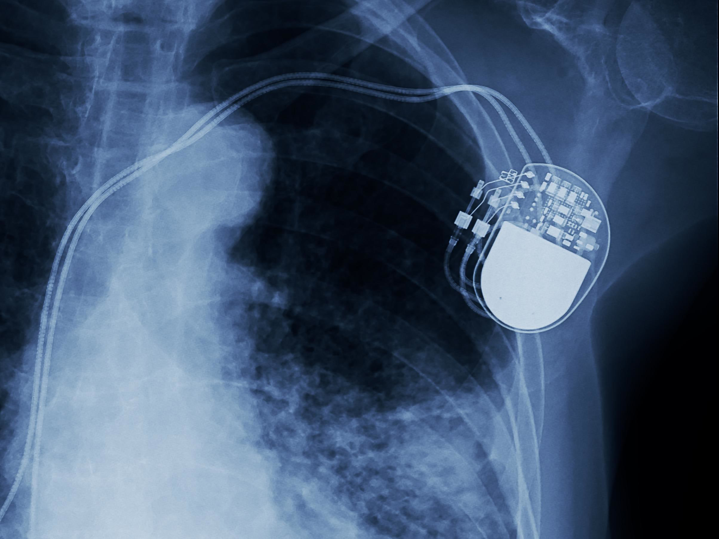 FDA Recalls 465,000 Pacemakers Over Cyber Security Threat