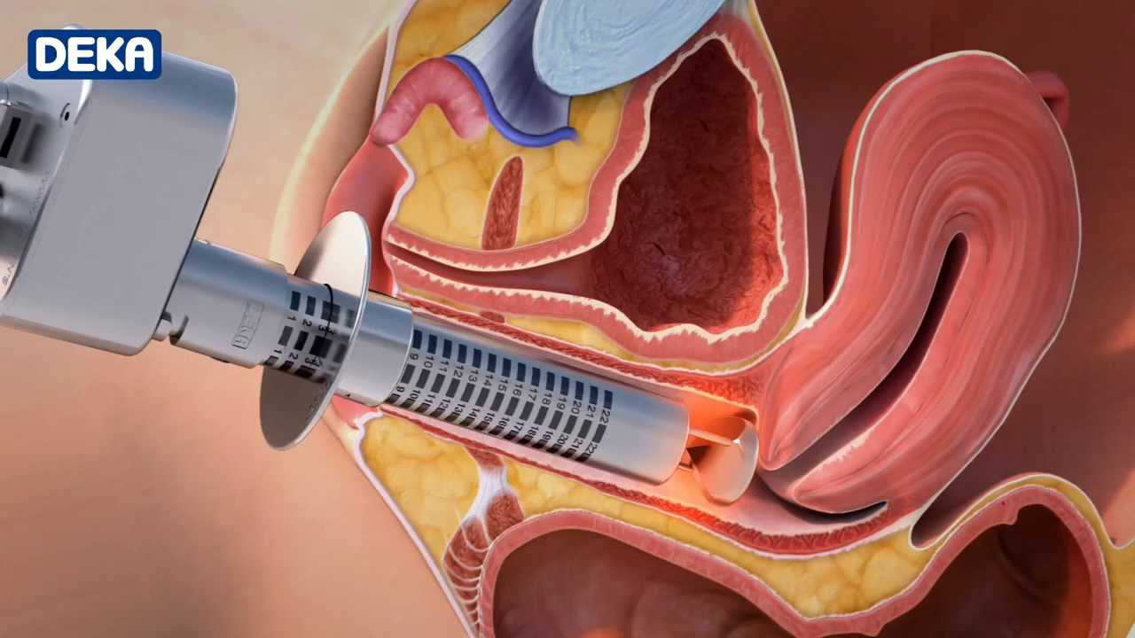 Rendering of a high heat MonaLisa Touch lasers potentially causing necrosis in a vaginal rejuvenation procedure.